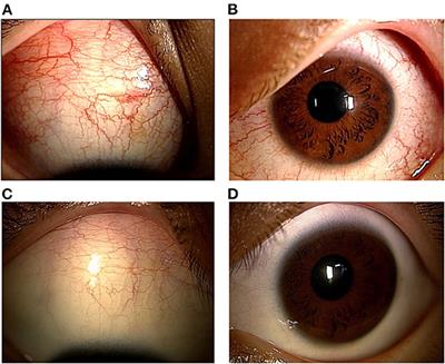 Case Report: Anterior Scleritis Presenting as a Primary Ocular Manifestation in Multisystem Inflammatory Syndrome in Children With COVID-19